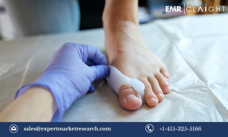 Hallux Valgus Treatment Market Size, Share, Trends, Growth, Report 2024-2032