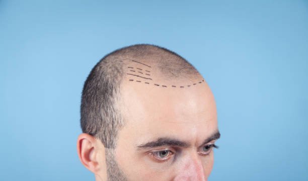 Is Hair Transplant Cost Worth the Investment?