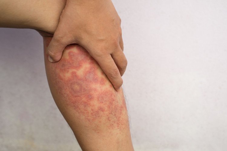 Investigating the effectiveness of new topical medications for eczema skin conditions